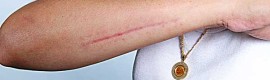 arm-scar